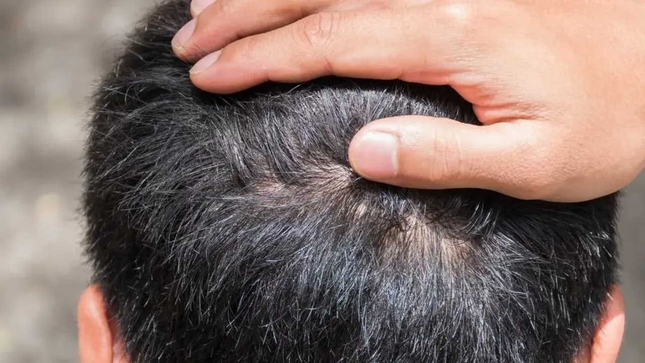 Saç derisinde kaşıntı olan hemen denesin: Kalıcı çözüm açıklandı