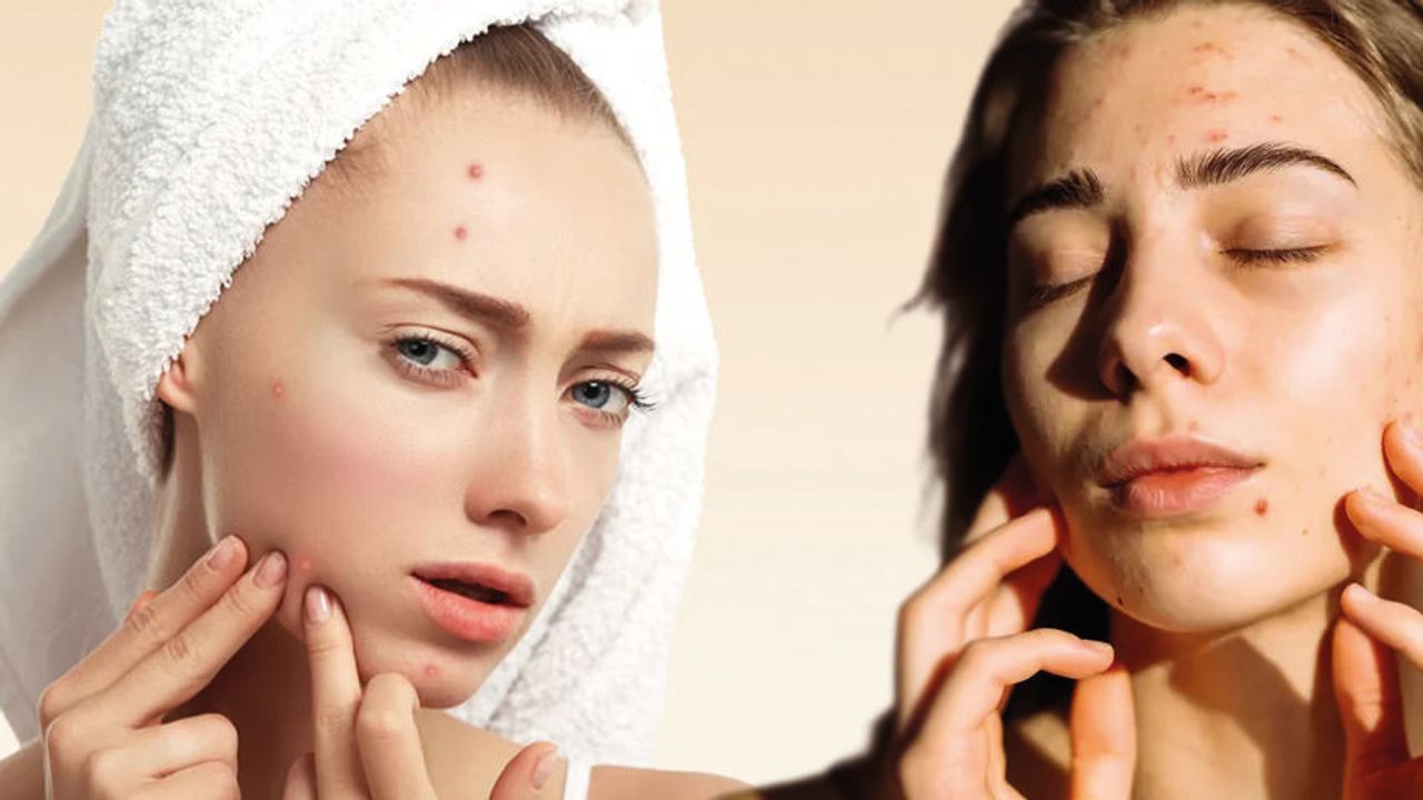 Yetişkinlikte Hormonal Akne Nedenleri ve Çözüm Yolları