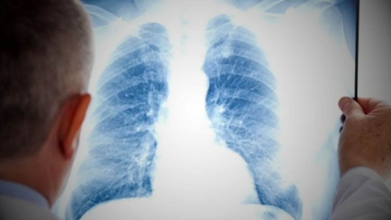 Her yıl 7 milyon kişiyi öldüren hastalık! 40 yaş üstü sigara içenlere kritik uyarı