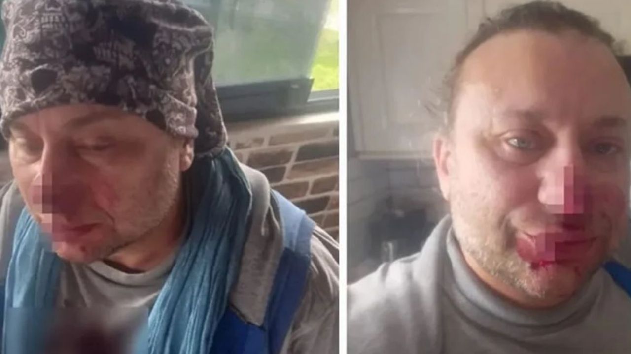 Felaket Telallı lakaplı şarkıcının yüzü çürümeye başladı! Entübe edildi