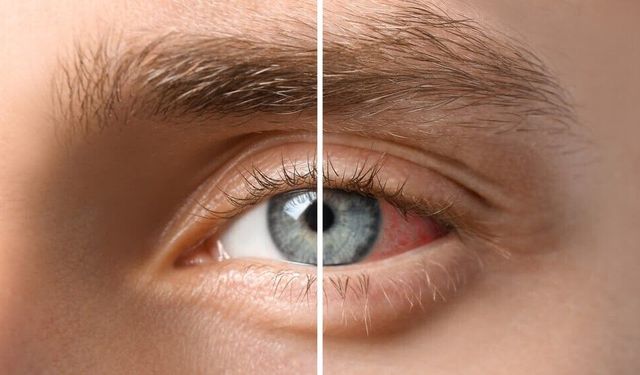 Gözlerde Geçmeyen Kızarıklığa Dikkat! Geç Kalırsanız Görmenizden Olabilirsiniz