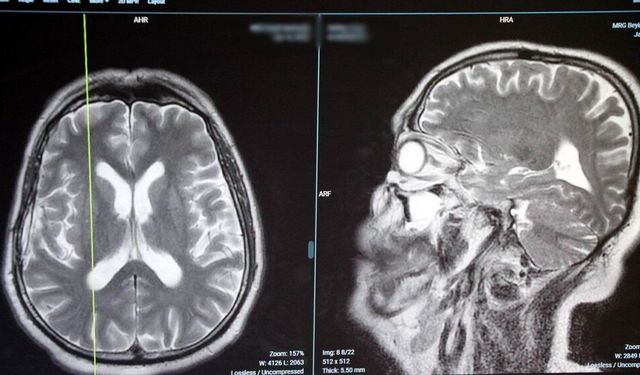  Beyin Tümörlerinde Zaman Kaybı Ölüme Yol Açıyor