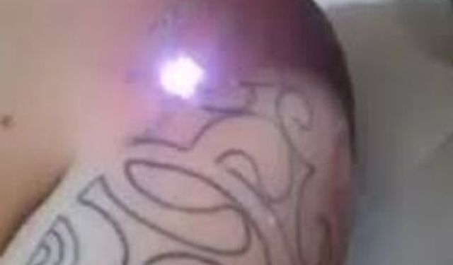 Dövme silmede süreci kısaltan yöntem  