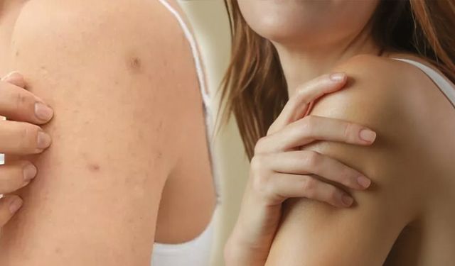 Kollarda ve Sırtta Çıkan Aknelerden Kurtulmanın 5 Etkili Yolu